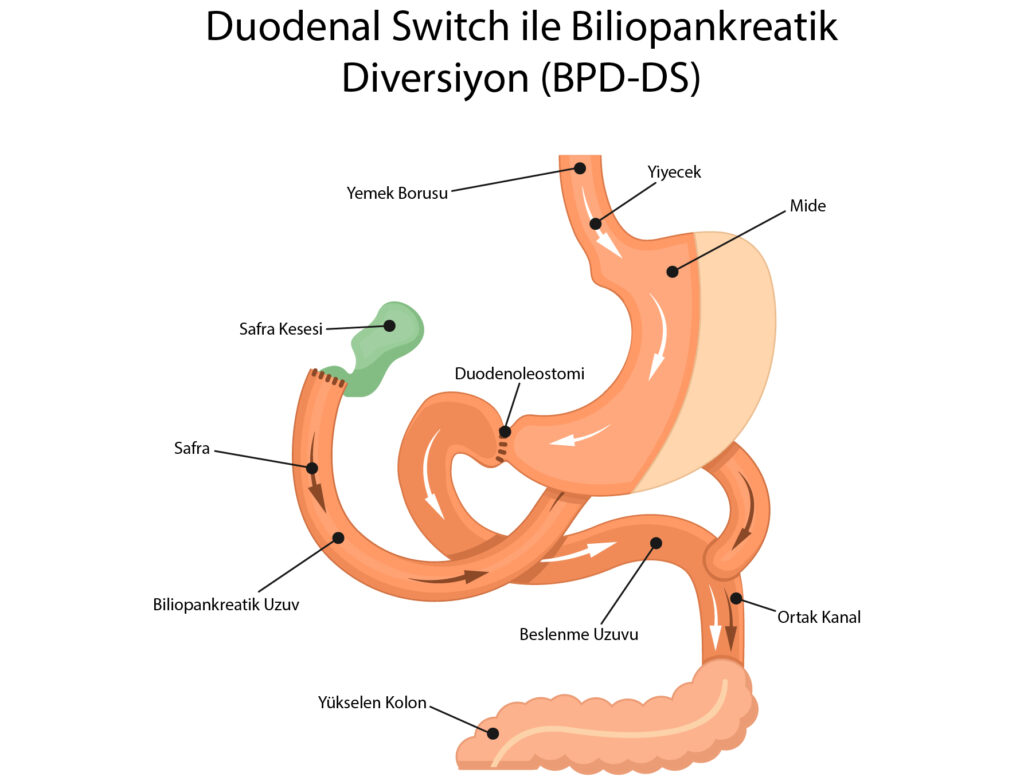 Duodenal Switch ile Biliopankreatik Diversiyon (BPD-DS)