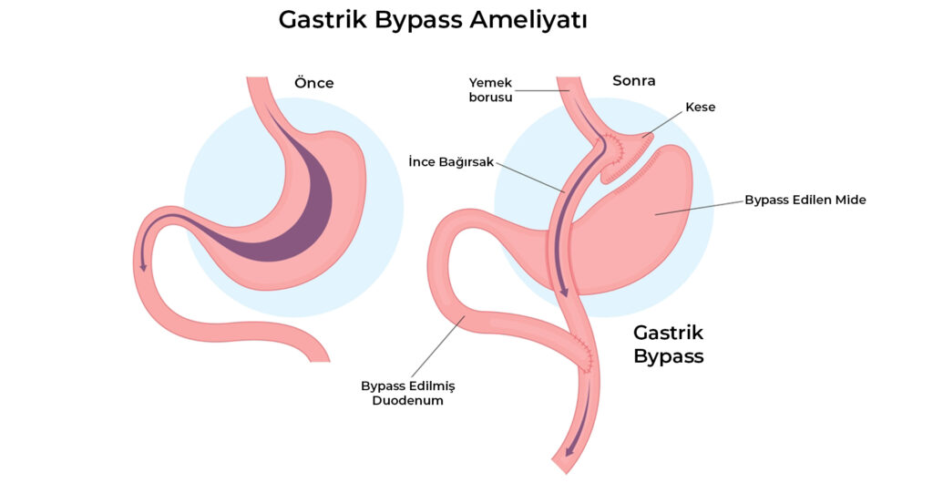 Gastrik Bypass