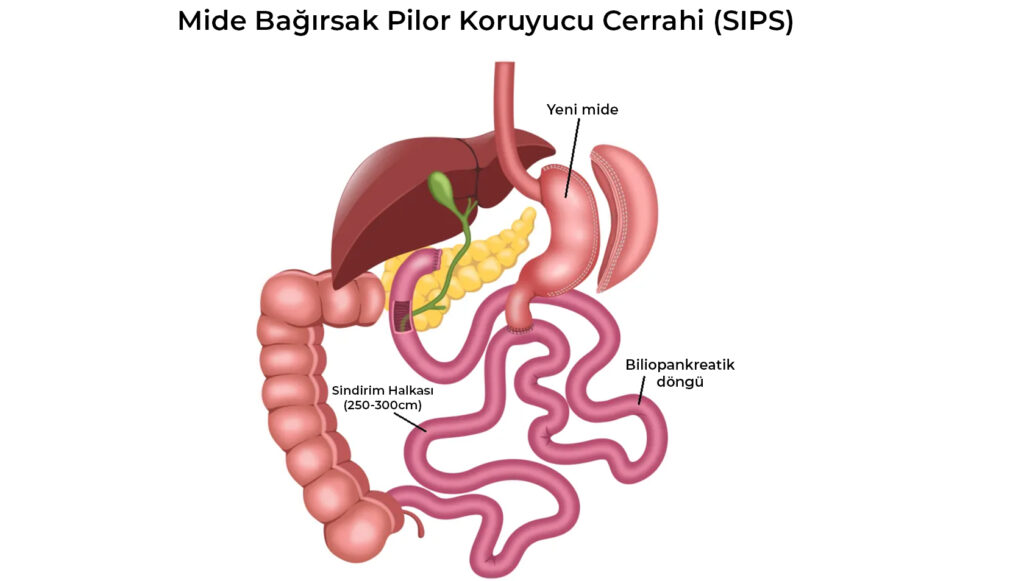 Mide Bağırsak Pilor Koruyucu Cerrahi (SIPS)