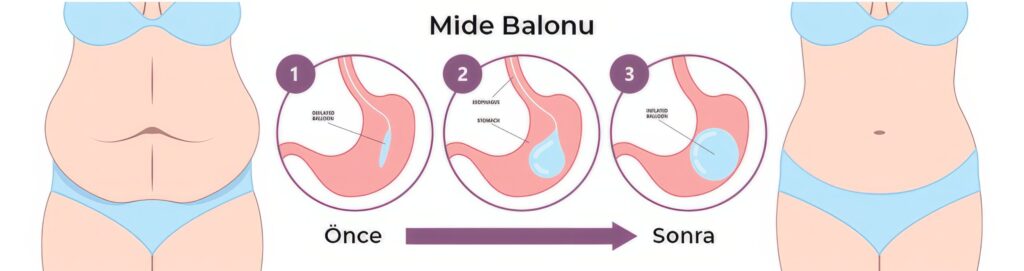 Mide Balonu Kilo Verme Aşamaları