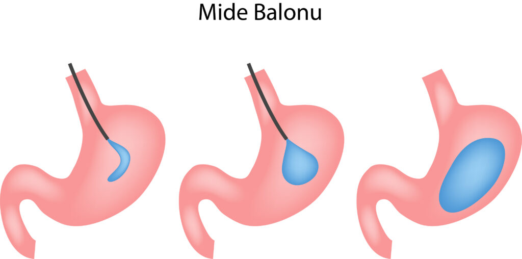 Mide Balonu Uygulaması