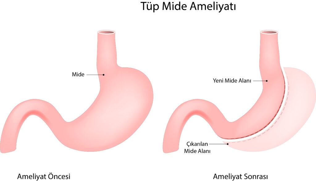 Tüp Mide Ameliyatı